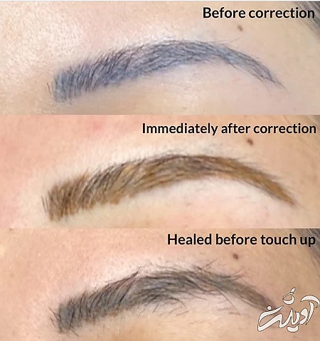 علت تغییر رنگ هاشور ابرو یا فیبروز, رنگ هاشور ابرو, تغییر رنگ فیبروز